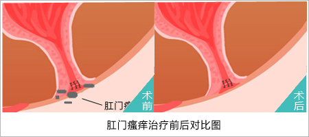 肛门瘙痒治疗前后对比.jpg