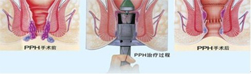 PPH手术过程示意图.jpg